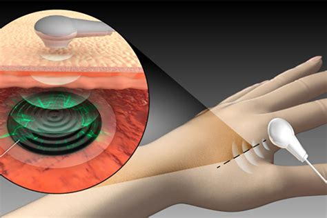  Polimeróxido de Etileno: El Futuro de las Implantes Médicos Duraderos y Biocompatibles!